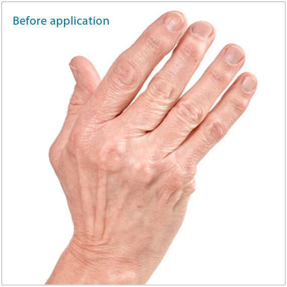 Shows fingers before using Polycentric. Rheumatoid Arthritis may cause your fingers to drift toward the little finger side of your hand. The Polycentric Hinged Ulnar Deviation Splint helps realign your fingers 