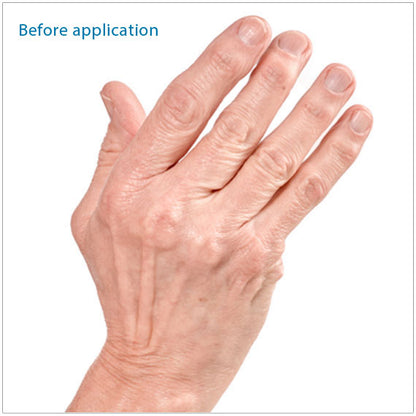 Shows fingers before using Polycentric. Rheumatoid Arthritis may cause your fingers to drift toward the little finger side of your hand. The Polycentric Hinged Ulnar Deviation Splint helps realign your fingers 